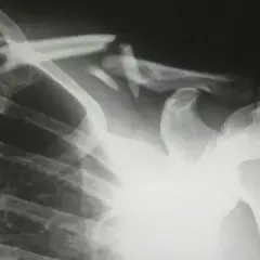 RTG klatki piersiowej uwidacznia złamanie nasady bliższej kości ramiennej z przemieszczeniem fragmentów. Widoczne żebra i obojczyk.