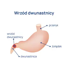 Jakie są objawy wrzodu dwunastnicy? Poznaj niebezpieczne sygnały