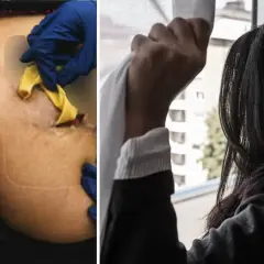 Närbild på en rumpa med synliga ärr och gula kompresser, troligen efter fillers i rumpan. Bredvid en kvinna som tittar ut genom ett fönster.