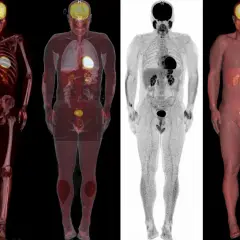 Vier medizinische Bilder zeigen den menschlichen Körper. Die PET/CT-Nachteile sind hier nicht ersichtlich, nur die Darstellung von Organen und Knochen.