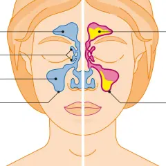 Vergleich gesunder Sinus und Rhinosinusitis: Entzündete Schleimhaut und vermehrte Schleimbildung sind typische nasennebenhöhlenentzündung symptome.