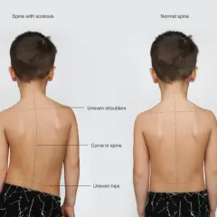 Porównanie kręgosłupa z bocznym skrzywieniem (skolioza co to) i prostego. Widać nierówne ramiona i biodra przy skoliozie.