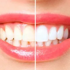 Sorriso diviso: a sinistra denti ingialliti, quasi senza smalto, a destra bianchissimi e splendenti.