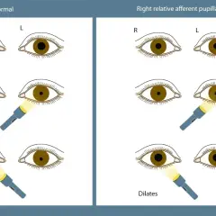 Ilustracja porównuje reakcję źrenic w oku normalnym i z prawostronnym deficytem aferentnym. Widoczna anizokoria, czyli nierówność źrenic, jest kluczowa w diagnostyce.
