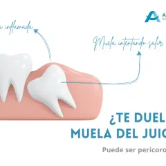 Ilustración de una muela del juicio impactada y encía inflamada, causando dolor de cabeza. Pregunta: ¿Te duele la muela del juicio?