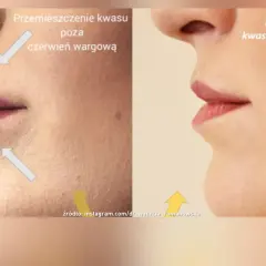Przed i po usunięciu kwasu hialuronowego z ust. Pokazuje efekt powiększania ust metodą na płasko i jego cofnięcie.