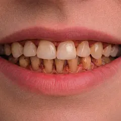 Boca con dientes amarillentos y encías inflamadas, mostrando signos de periodontitis crónica.