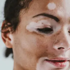 Portret kobiety z widocznym **vitiligo** na twarzy. Jasne plamy kontrastują z jej ciemniejszą skórą, tworząc unikalny wzór.