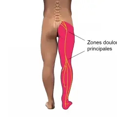 Schéma montrant les zones douloureuses principales d'une jambe, suggérant un mal aux cuisses la nuit.