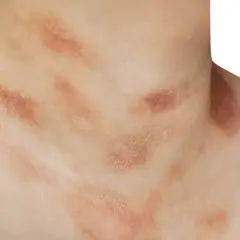 Hautirritationen am Hals, die wie ein pilzartiger Ausschlag aussehen, mit roten, schuppigen Flecken.