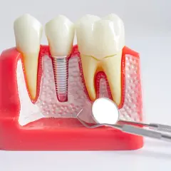 Modello dentale con impianto: anche con la piorrea si possono mettere i denti fissi. Strumenti dentistici in primo piano.
