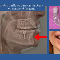 Rentgen żuchwy z nieprawidłową pozycją, szyna relaksacyjna twarda. Czerwony X oznacza błąd.