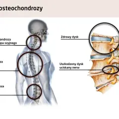 Ilustracja pokazuje ucisk na nerw szyjny objawy. Widoczna osteochondroza kręgosłupa szyjnego, piersiowego i lędźwiowego.