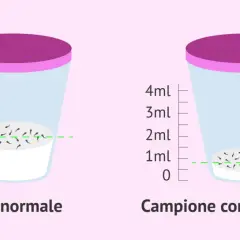 Confronto tra campione normale e ipospermia. La curiosità quando un uomo non viene, mostra una ridotta quantità di spermatozoi.
