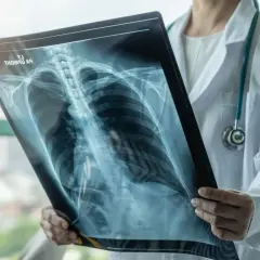 Lekarz analizuje RTG klatki piersiowej, szukając oznak odmy płucnej. Czy można umrzeć? Szybka diagnoza ratuje życie.