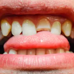 Primer plano de una boca abierta mostrando dientes delanteros con grietas visibles y una lengua rosada.