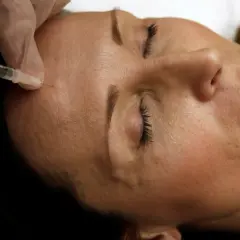 En hand i handske ger en injektion med en spruta i en kvinnas panna. Detta är en del av en behandling med botox på recept.