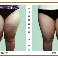 Liposukcja ud: Ile kosztuje i od czego zależy cena?