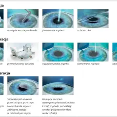 Ilustracje pokazują etapy korekcji wzroku laserem: PRK, LASIK i SMILE. Każda metoda poprawia widzenie.