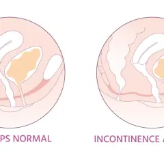 Schéma comparant le périnée féminin normal et en cas d'incontinence à l'effort. L'irritation périnée femme peut être liée à ces fuites.