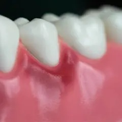 Detalle de dientes y encías, mostrando una leve inflamación en la encía de una muela.