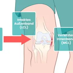 Schema zeigt Kniegelenk mit Kraftwirkung von außen, die zu einem verletzten Innenband (MCL) führt.