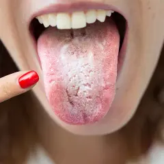 Una persona se señala la lengua, que se ve blanca y con una textura áspera y seca, indicando posible candidiasis oral.