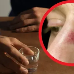Dłoń sięga po kieliszek, a na policzku widoczne pajączki – objawy długotrwałego alkoholizmu.