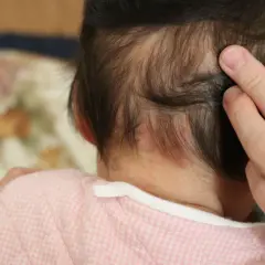 Piccolo bebè con macchie rosse sul collo, forse un morso della cicogna.
