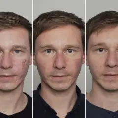 Jak przyspieszyć gojenie po laserze frakcyjnym? Skuteczne porady