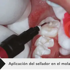 Aplicación de sellante dental en el molar 46. Un aplicador dental deposita el material en las fisuras del diente.