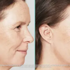 Porównanie skóry przed i po zabiegu skinbooster. Wygładzone zmarszczki, nawilżona i promienna cera.