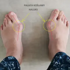 Ile trwa operacja haluksa? Czas zabiegu i co warto wiedzieć