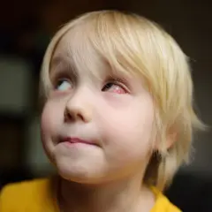 Zbliżenie na twarz dziecka z zaczerwienionym, podrażnionym okiem.