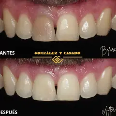 Antes y después de tratar un diente muerto. El diente oscuro se ha blanqueado y restaurado para que coincida con los demás.