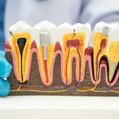 Model zęba pokazuje budowę zębiny, miazgi i korzenia. Widać różne etapy leczenia, w tym wypełnienie kanału korzeniowego i implant.