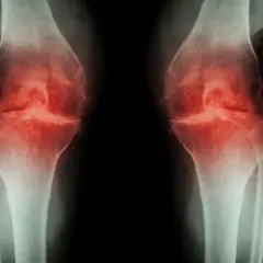 RTG kolan z zaznaczonymi zmianami zapalnymi. Widoczne zwężenie przestrzeni stawowych, sugerujące chorobę zwyrodnieniową, która może wymagać osteotomii.