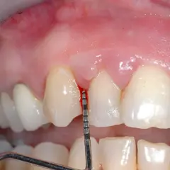 Strumento dentale misura la profondità gengivale. Alcuni credono che la pulizia dei denti rovina i denti, ma è fondamentale per la salute orale.