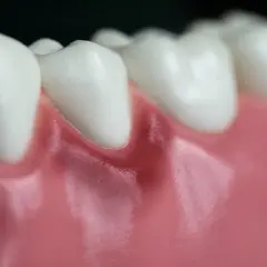 Detalle de dientes blancos y una encía roja en un diente, mostrando la línea de la encía.