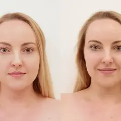 Przed i po zabiegu zaffiro. Uśmiechnięta kobieta z blond włosami, z widoczną poprawą skóry.