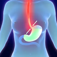 Illustrazione anatomica che mostra un esofago irritato e uno stomaco con reflusso, suggerendo ansia e strane sensazioni allo stomaco.
