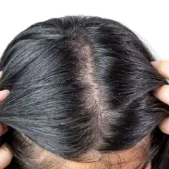 Cuoio capelluto con forfora visibile, sintomo comune della dermatite seborroica. Mani che separano i capelli scuri per mostrare le squame bianche.