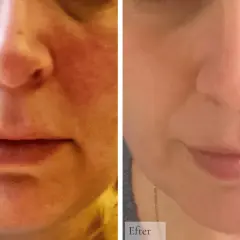 Före och efterbilder visar en minskning av rodnad och synliga blodkärl, vilket indikerar förbättrad rosacea hud.