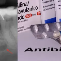 Radiografia di un ascesso dentale con confezioni di antibiotico amoxicillina/acido clavulanico.