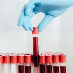 Ręka w niebieskiej rękawiczce wyjmuje probówkę z krwią z rzędu innych. Wyniki morfologii krwi czekają na analizę.