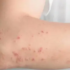 Skóra z zaczerwienionymi, swędzącymi zmianami, które mogą być związane z reakcją na miód a histamina.