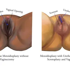 Comparaison de deux procédures chirurgicales pour transformer un pied mâle en femelle : la métoidioplastie simple et la métoidioplastie avec allongement urétral, scrotoplastie et vaginectomie.