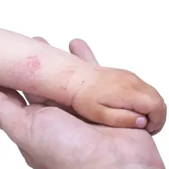 Mano di un adulto che tiene il braccio di un bambino con eczema. La pelle del bambino è arrossata e screpolata, mostrando i segni tipici dell'eczema nei bambini.