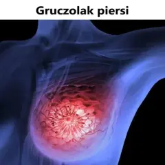 Schemat piersi z zaznaczonym gruczolakiem.
