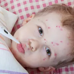 Dziecko z gorączką i widocznymi objawami ospa wietrzna na twarzy, z termometrem w ustach.
